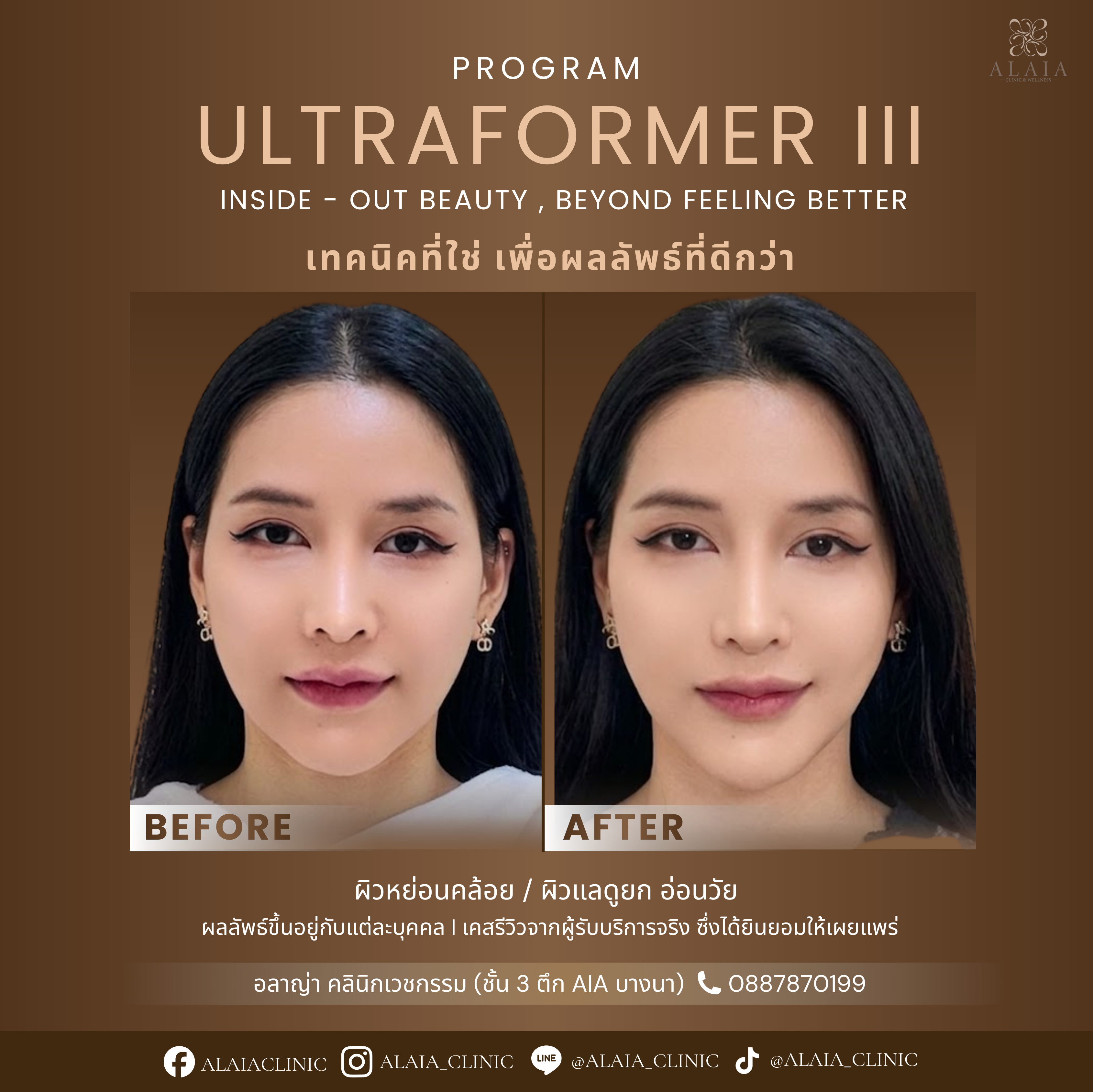 B&A 5